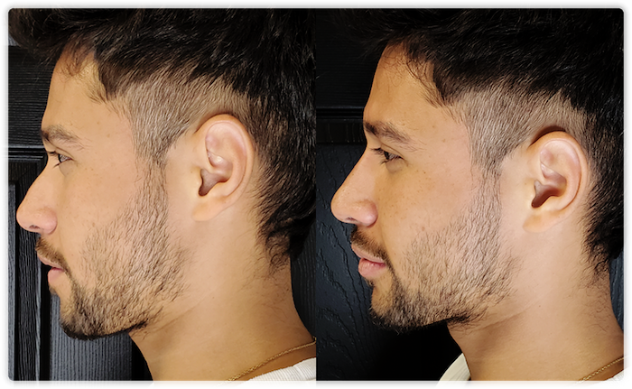 Non Surgical Facelift 2